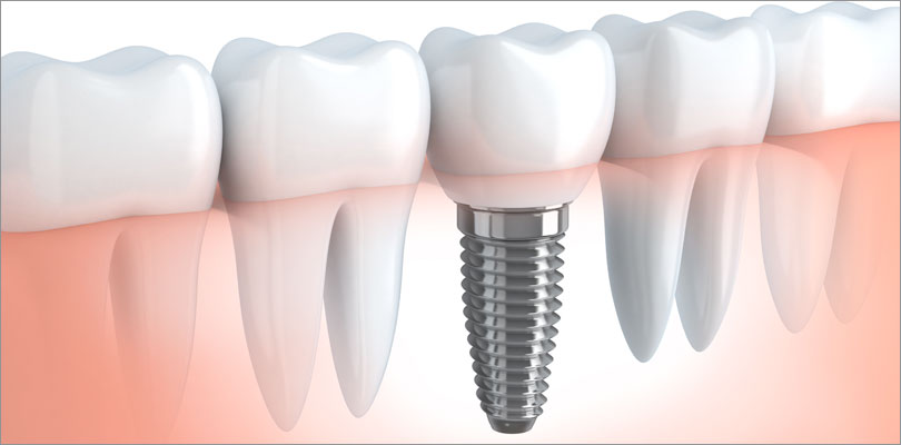 Dental Implants North Road, Port Coquitlam