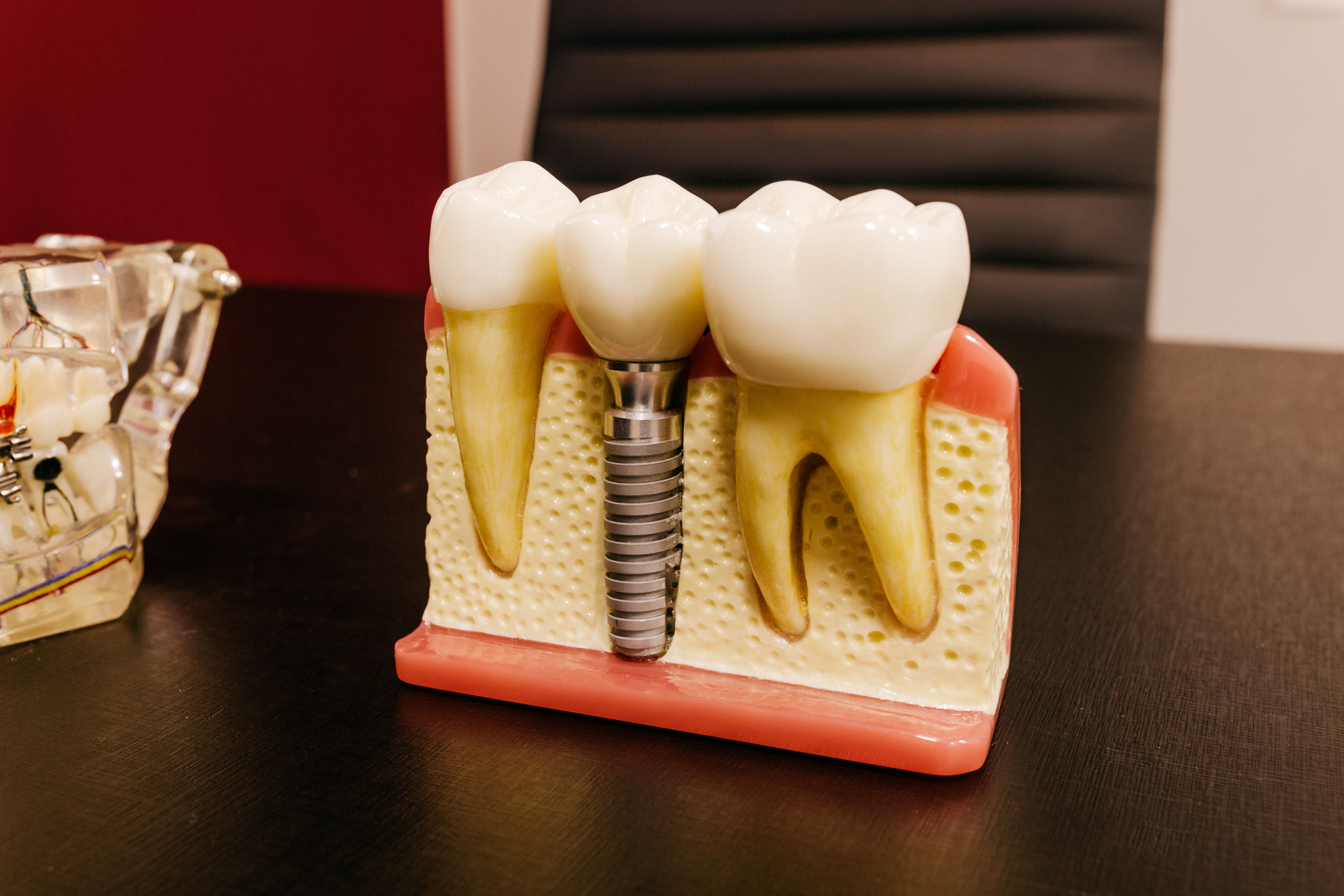 dental implants after tooth loss
