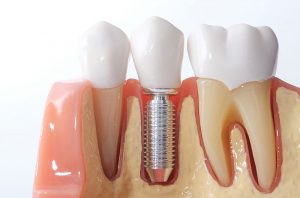 brookemeredental_blog_what_are_the_benefits_of_dental_implants
