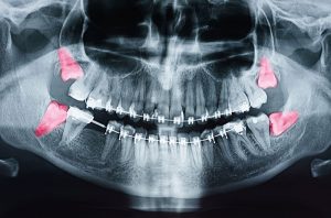 brookemeredental_blog_signs_that_you_may_need_to_removed