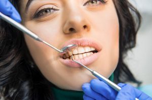brookmeredental_receding_gums_treatment_4_things_you_need_to_know