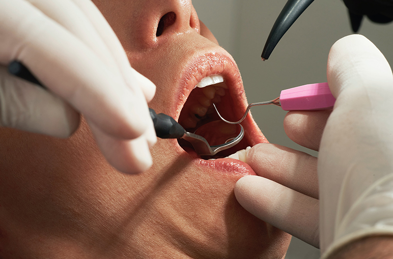 4 Tooth Decay Treatments That Do Not Include Extraction