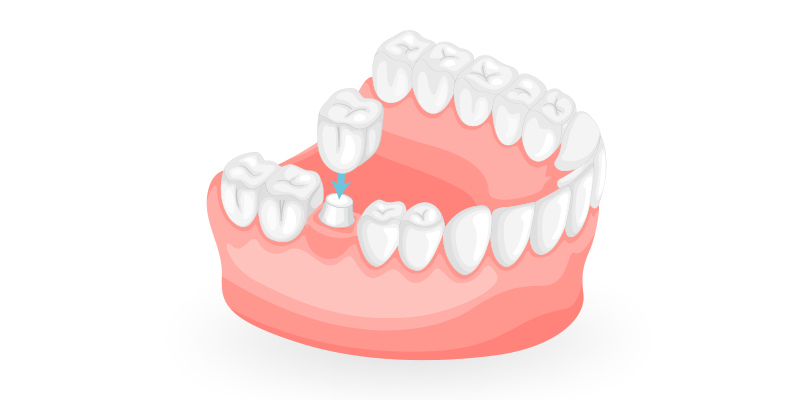 Dental Crown Coquitlam
