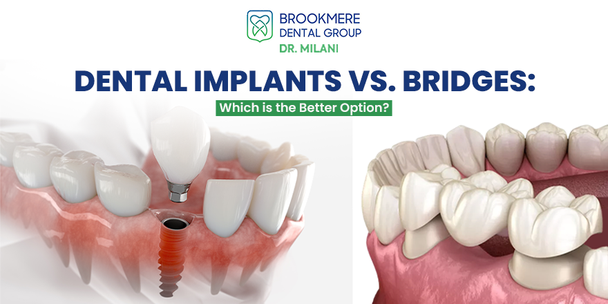 Dental Implants vs. Bridges: Which is the Better Option?