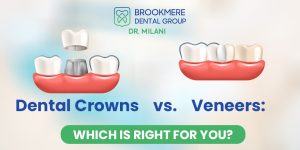 Dental Crowns vs. Veneers: Which is Right for You?