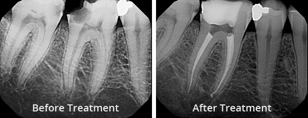 root canal before and after