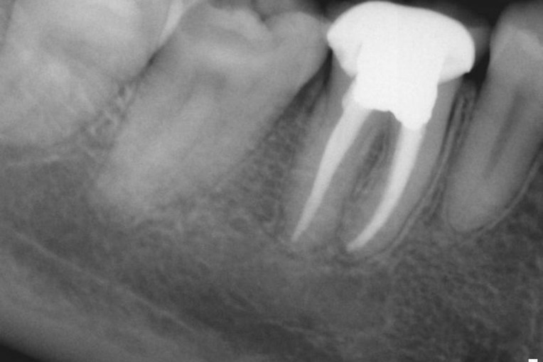 root canal results
