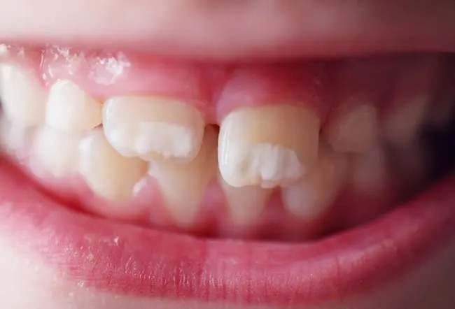 Why White Spots Appear on Teeth and the Best Ways to Treat Them